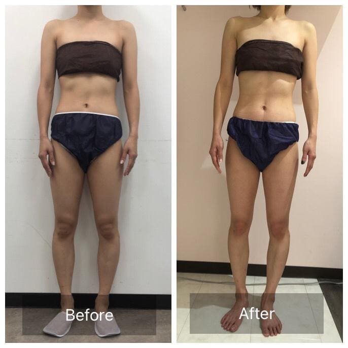 ビフォーアフター - 全身痩身コース Before