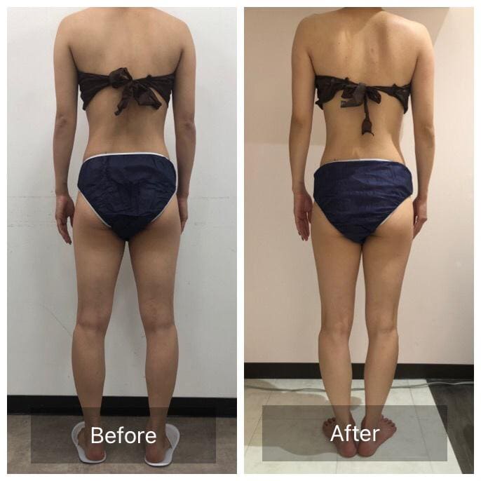 ビフォーアフター - 全身痩身コース After
