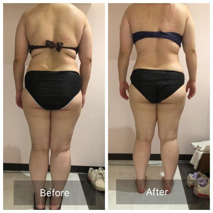 ビフォーアフター - 全身痩身コース After